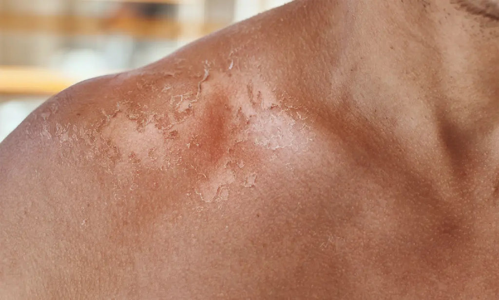 How to Treat Skin Burns from Skincare Products or Peels