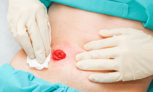 Healing Pressure Ulcers with Collagen: Evidence-Based Insights for Better Results