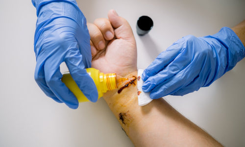 How to Manage Wounds in Diabetic Patients