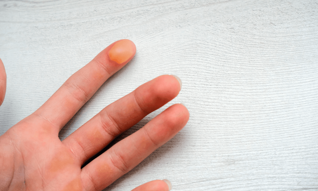 How to Treat Blisters and Skin Irritations