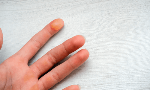 How to Treat Blisters and Skin Irritations