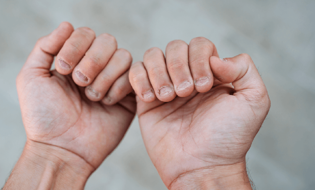 How to Fix Brittle Nails Naturally: What Actually Works?